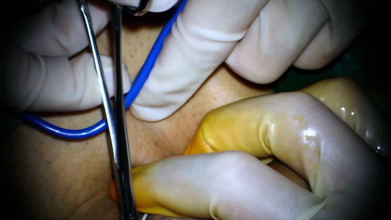 Microscopic Electric Rotary Grinding of Plaques Combined with Graft Repair in the Management of Peyronie's Disease