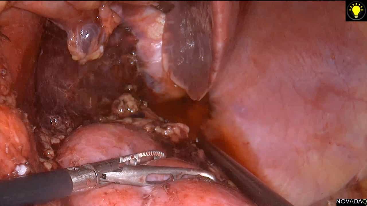Laparoscopic Posterior Radical Antegrade Modular Pancreatosplenectomy for Distal Pancreatic Carcinoma