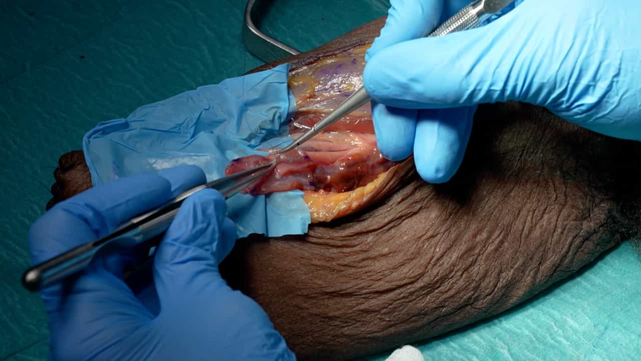 Author Spotlight: Regenerative Peripheral Nerve Interface (RPNI) Surgery in Postamputation Pain Management