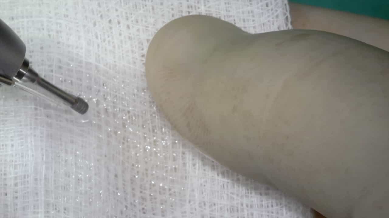 Surgical Bone Implantation Technique for Rat Tibia Models of Diabetes and Osteoporosis