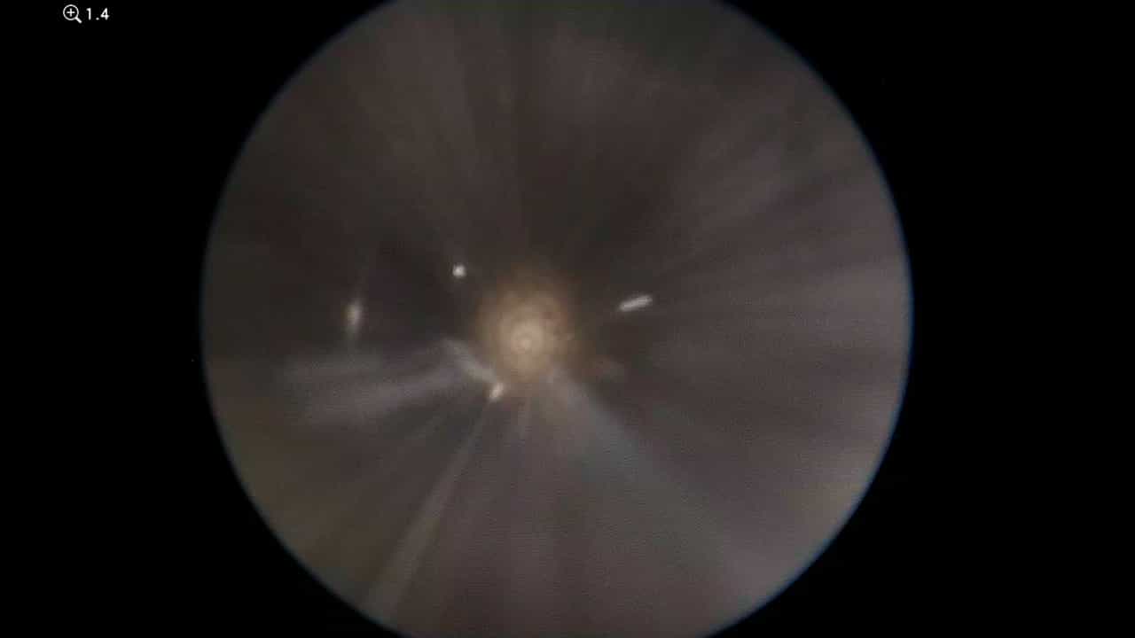Author Spotlight: A Single-Entry Point Endoscopic Intraventricular Approach for Third Ventriculostomy and Pineal Biopsy