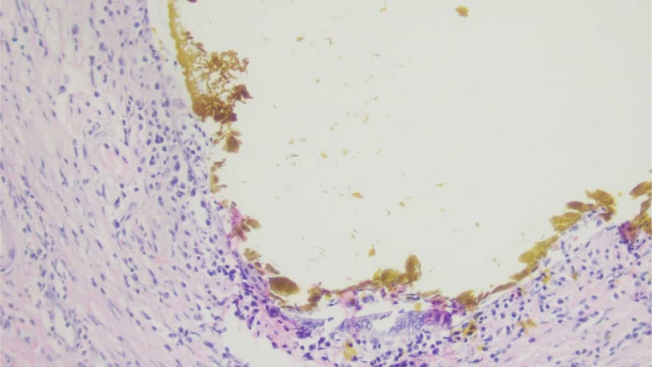 Author Spotlight: Advancing Hepatobiliary and Pancreatic Tumor Treatment with Minimally Invasive Surgical Techniques