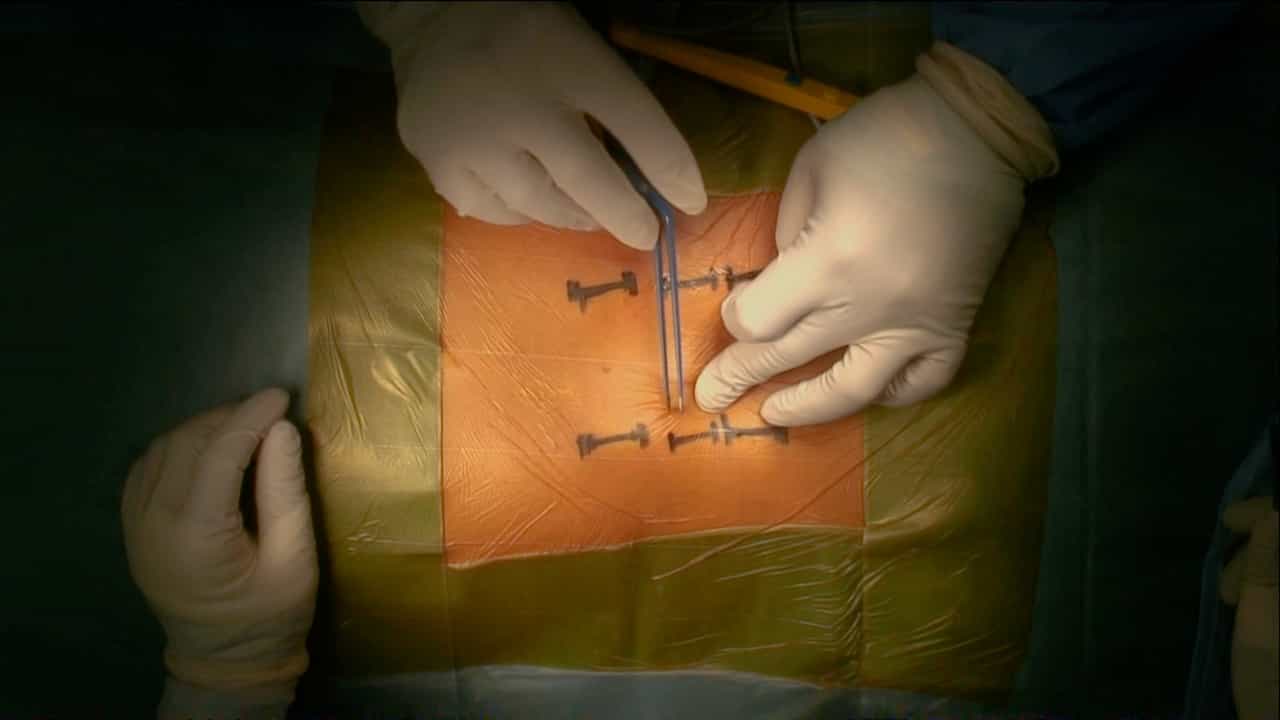 Minimally Invasive Treatment for Thoracolumbar Burst Fracture Using Sagittal Alignment Screws and A Trauma Reduction Device