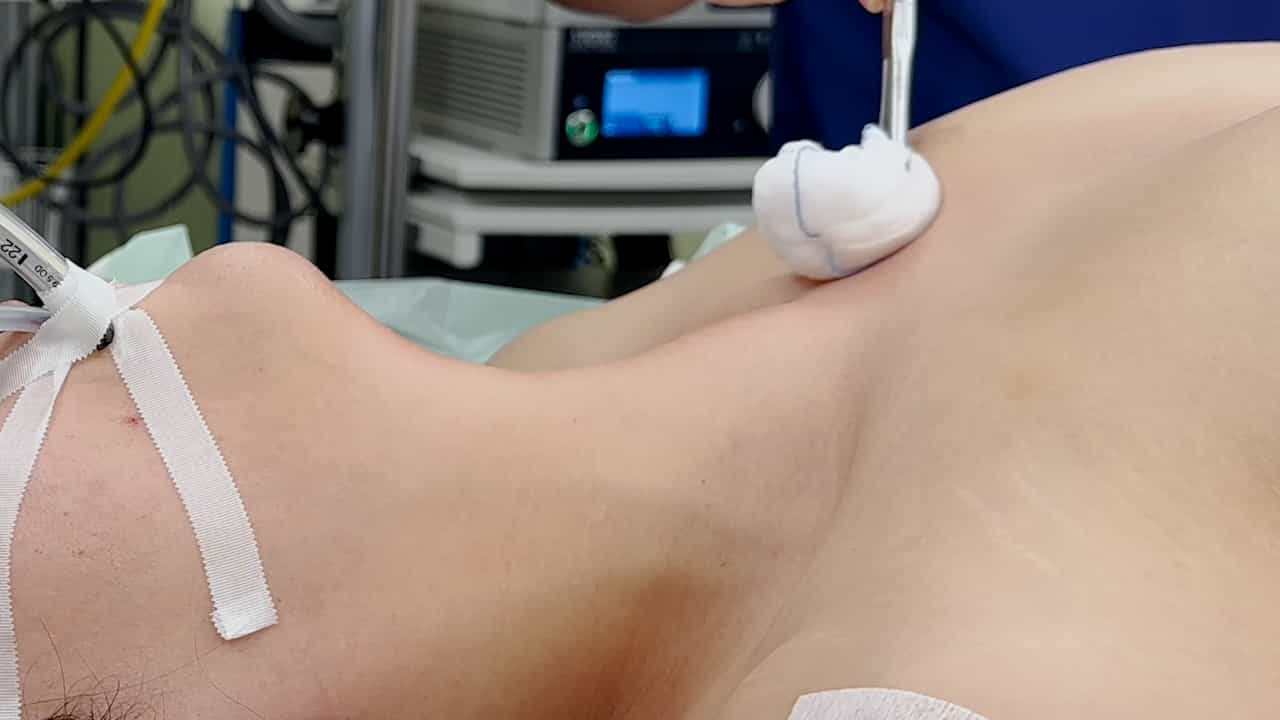 Minimal Invasive Resection of Large Retrosternal Thyroid Goiter