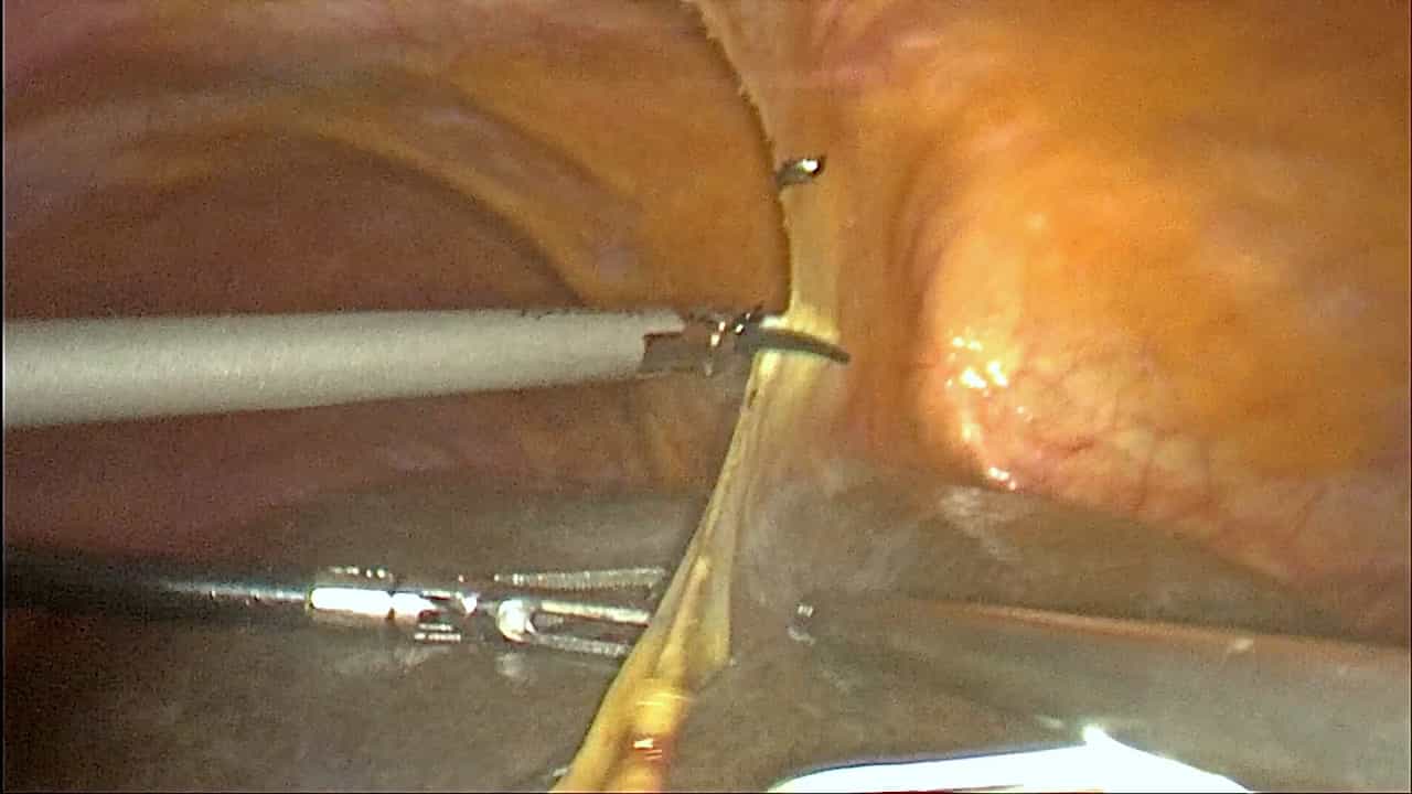 Complete Laparoscopic Radical Resection of Perihilar Cholangiocarcinoma Type IIIb