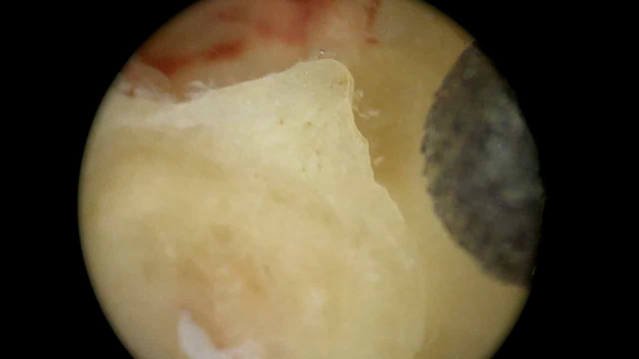 Harvest of Vestibular End-Organs under Physiologic Conditions during Labyrinthectomy