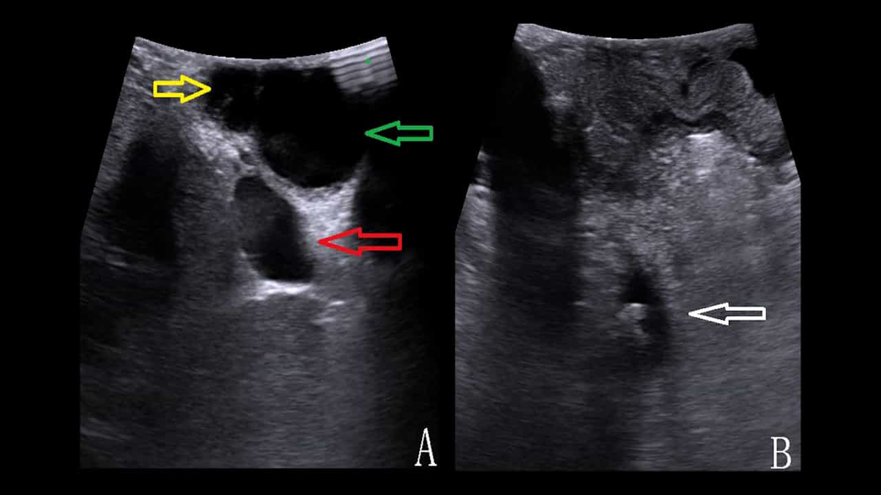 Application of Laparoscopic Ultrasonography in Primary Choledochal Suture during Combined Two-lens Surgery
