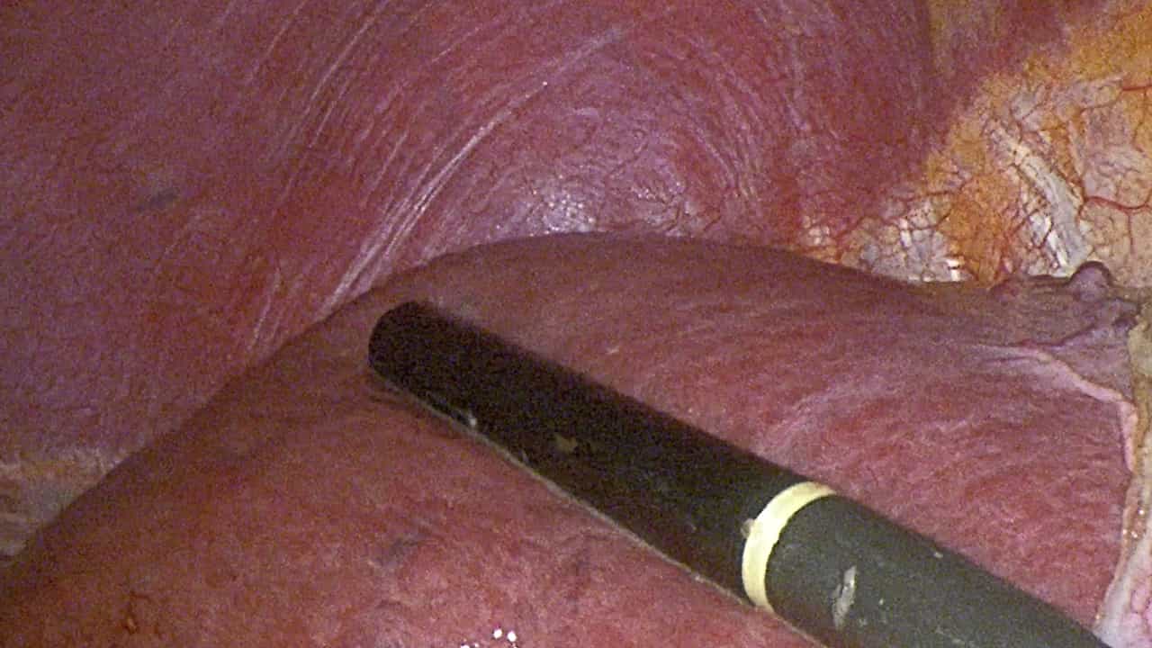 Laparoscopic Anatomical Hepatectomy Using Takasaki's Approach and Indocyanine Green Fluorescence Navigation