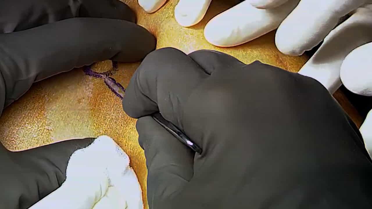 Anterior Capsular Reconstruction with Human Dermal Allograft for Irreparable Subscapularis Tears