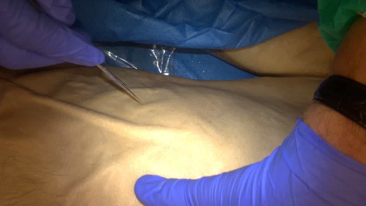 The Role of Anatomical Dissection in Defining Colic and Small Bowel Artery Lymphovascular Bundles in the D3 Volume of Small and Large Bowel Mesentery