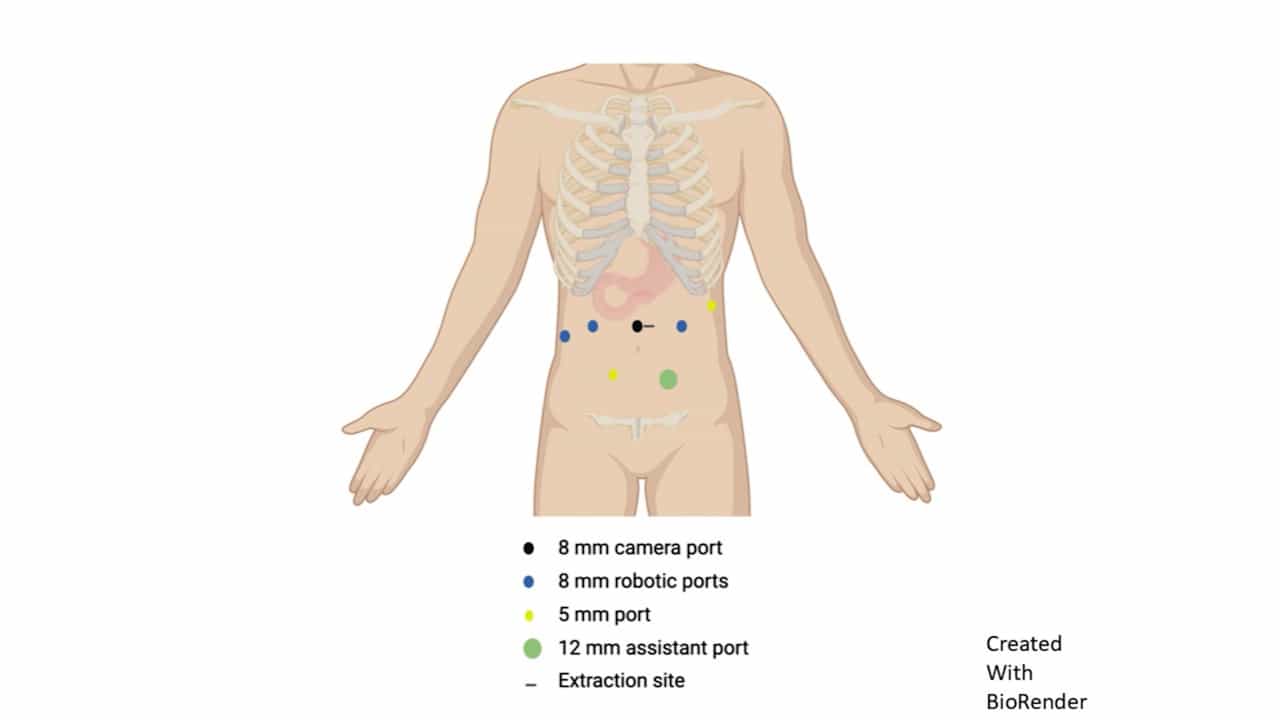 Robotic Duodenal Sleeve Resection for Gastrointestinal Stromal Tumor with Rare Exon 8 KIT Mutation Following Neoadjuvant Imatinib