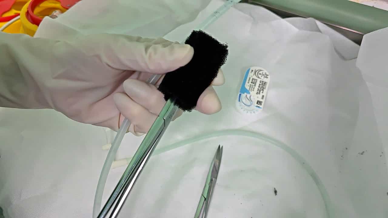 Endoscopic Vacuum Therapy for the Treatment of Anastomotic Leakage after Total Gastrectomy with Esophagojejunostomy