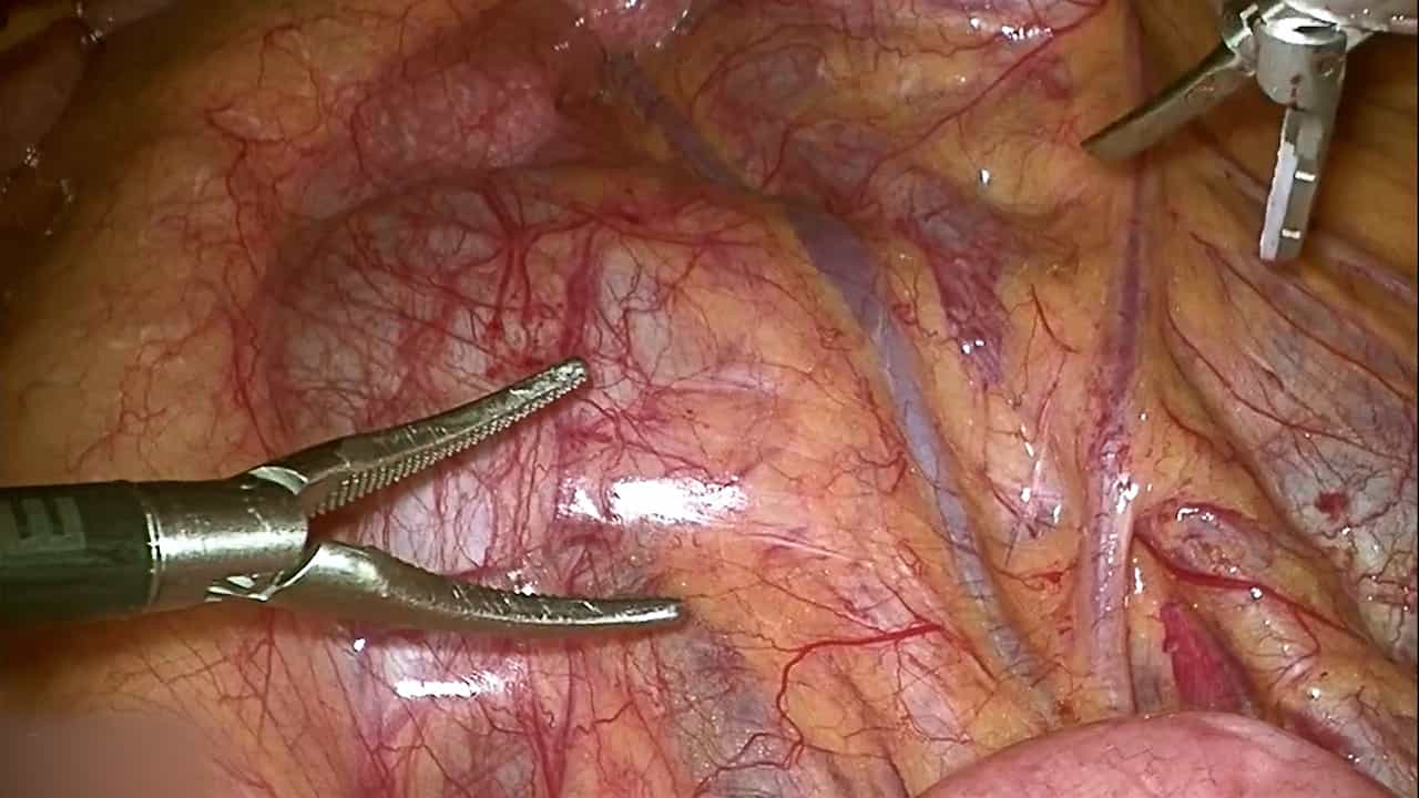 Transmesenteric Laparoscopic Pyeloplasty in Trendelenburg Position for Horseshoe Kidney with Hydronephrosis