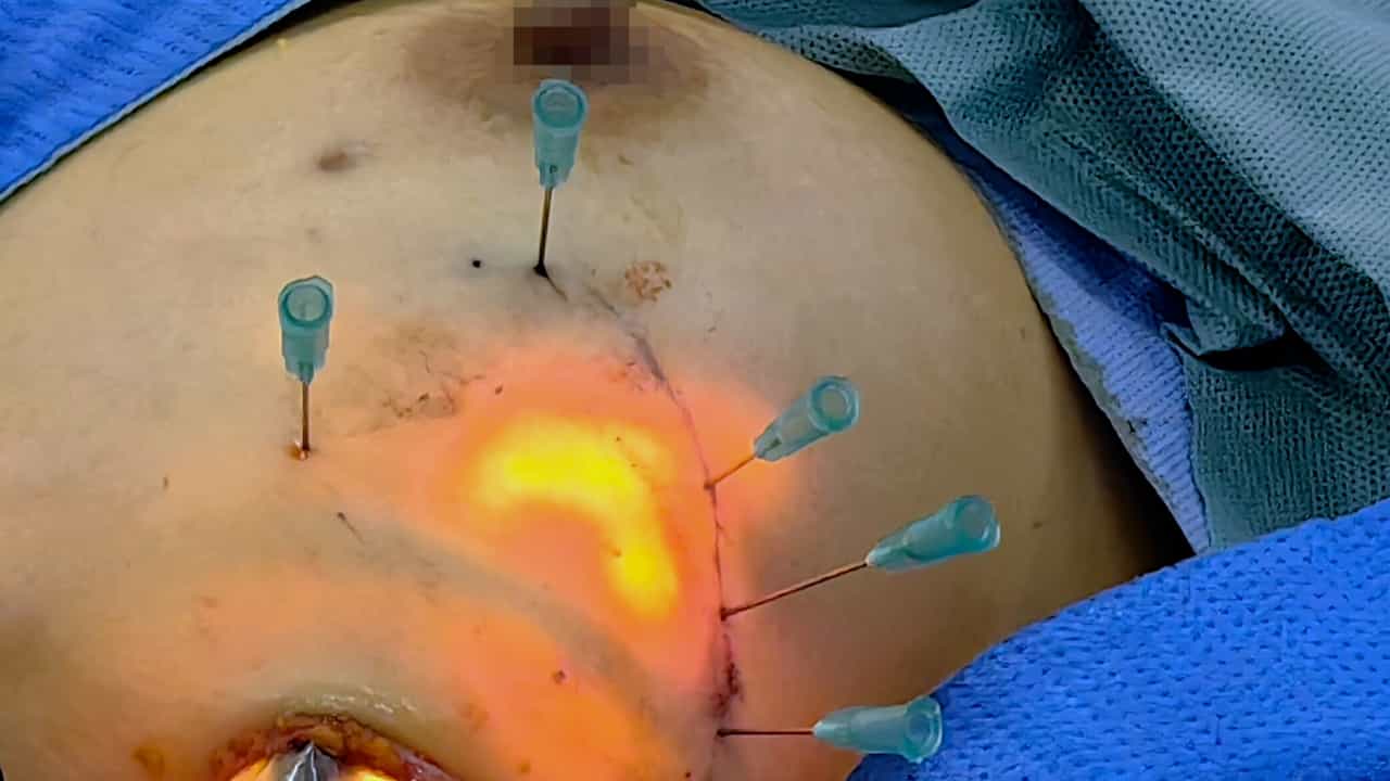 Single-Port Robotic-assisted Transaxillary Breast-conserving Surgery: A Prospective, Single-arm, Non-randomized Phase IIa Clinical Trial