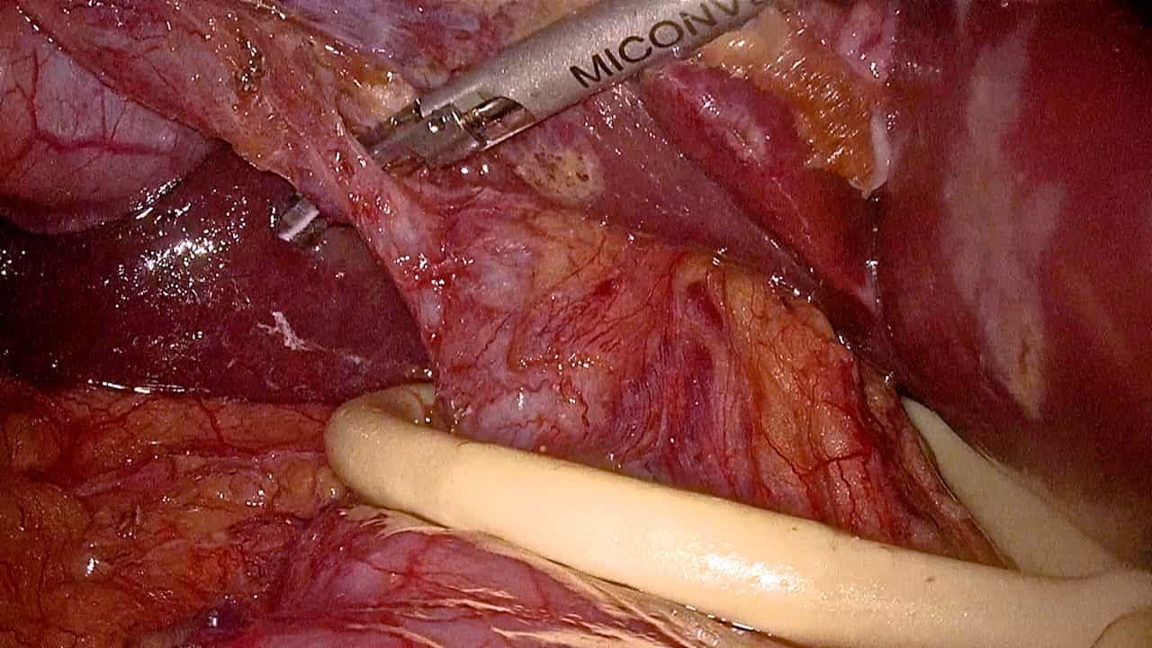 Laparoscopic Anatomical Right Hemihepatectomy via the In Situ Anterior Approach
