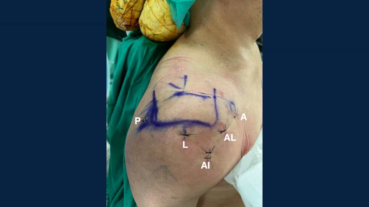 Knotless Independent Double-Row Repair and Biceps Augmentation for Anterosuperior Rotator Cuff Tears