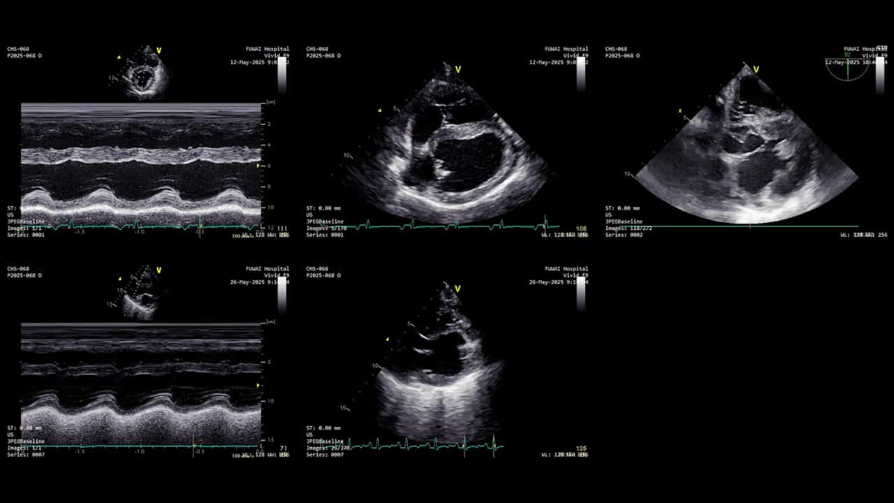 Implantation of Left Ventricular Assist Device (LVAD) in Juvenile Landrace Swine: A LVAD Implantation Model of Pediatric Heart Failure