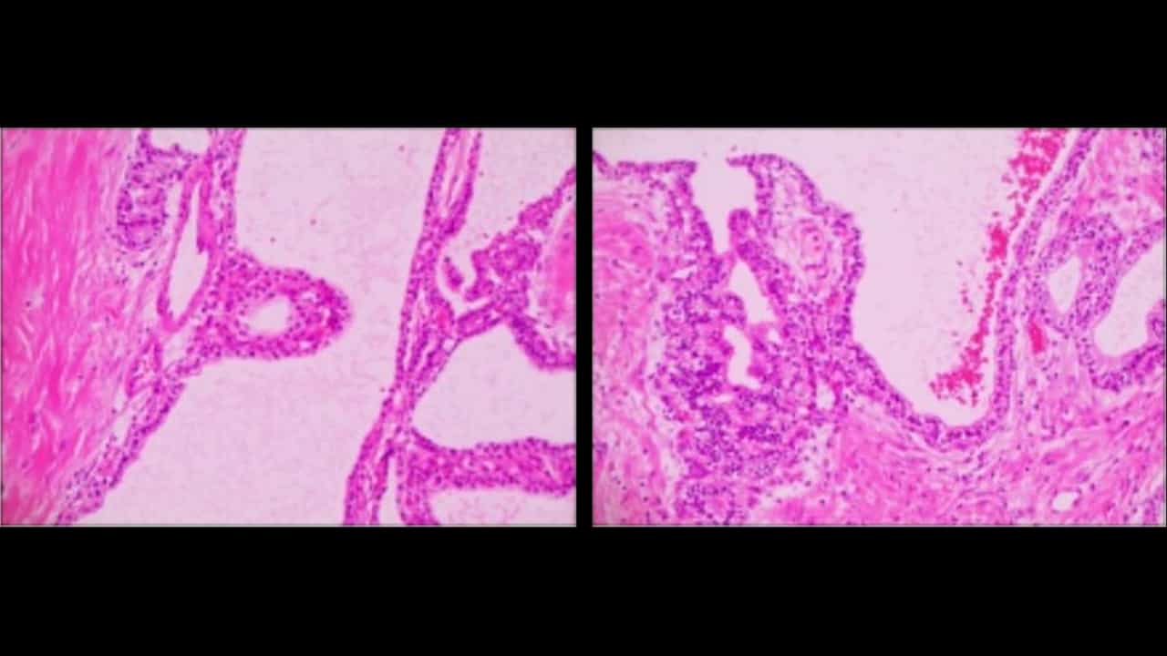 Treatment of Middle-segment Pancreatic Benign Tumor Using Laparoscopic Central Pancreatectomy with End-to-end Pancreatic Duct Reconstruction