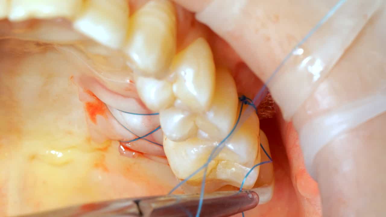 A Simplified Protocol for Protecting Palatal Soft Tissue Donor Sites Using an Oral Mucoadhesive Bandage