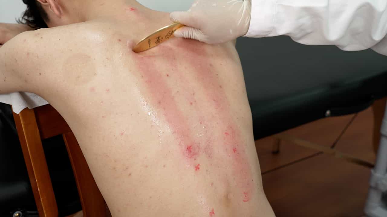 A Standardized Copper Bian-Stone Gua Sha Protocol for Treating Chronic Fatigue Syndrome in Human Subjects