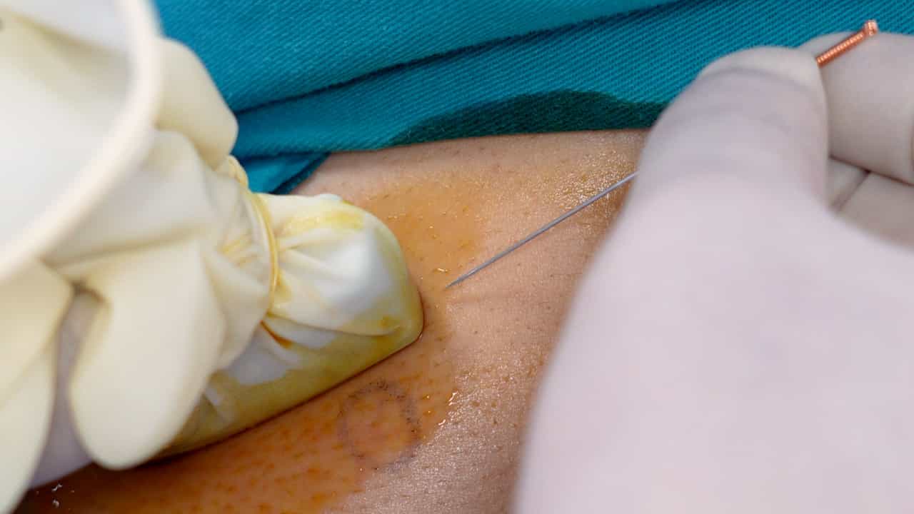 Ultrasound-Guided Acupotomy Release With Biomechanical Assessment For Trapezius Myofascial Pain Syndrome