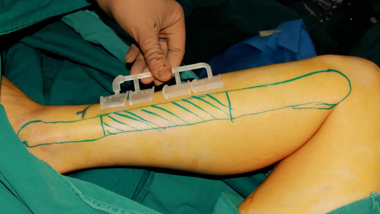 Digitally Guided Intraoral Segmental Mandibulectomy and Fibula Flap Reconstruction for Locally Invasive Odontogenic Tumors