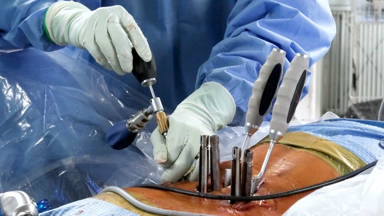 Full-Endoscopic Trans-Kambin Triangle Lumbar Interbody Fusion: Surgical Technique