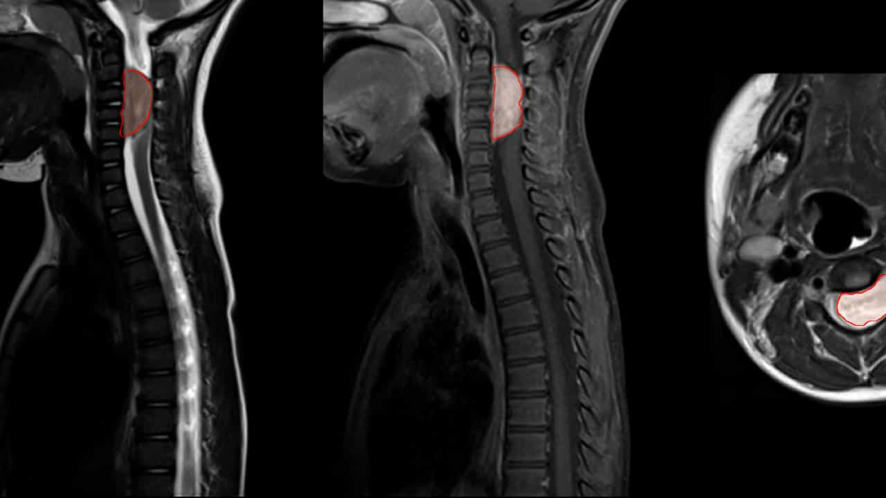 Posterior Approach for Microsurgical Resection of a Ventrolateral Cervical Ganglioneuroma: an Illustrative Case and Technical Report
