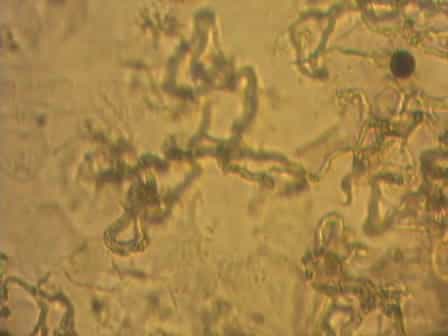 The MODS method for diagnosis of tuberculosis and multidrug resistant tuberculosis