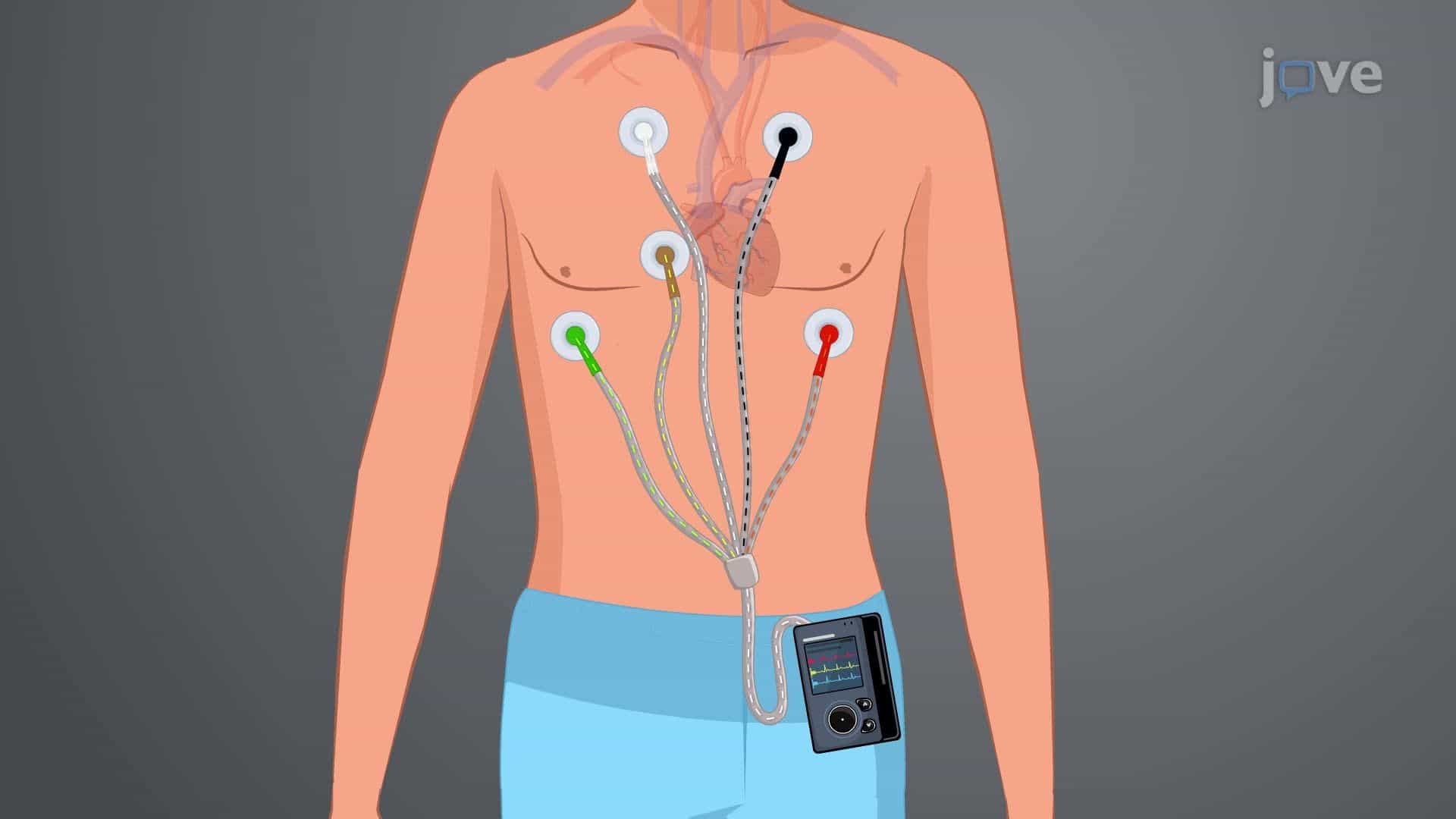Holter Monitor: 24-Hour Monitoring