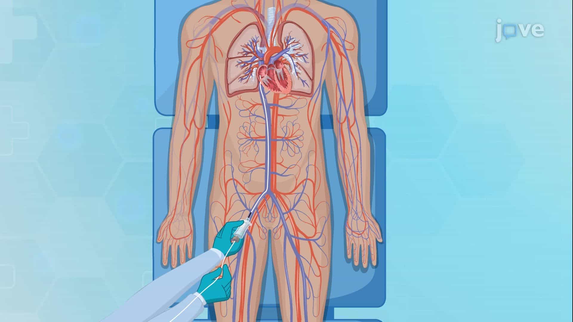 Cardiac Catheterization I: Pre-Procedure Overview