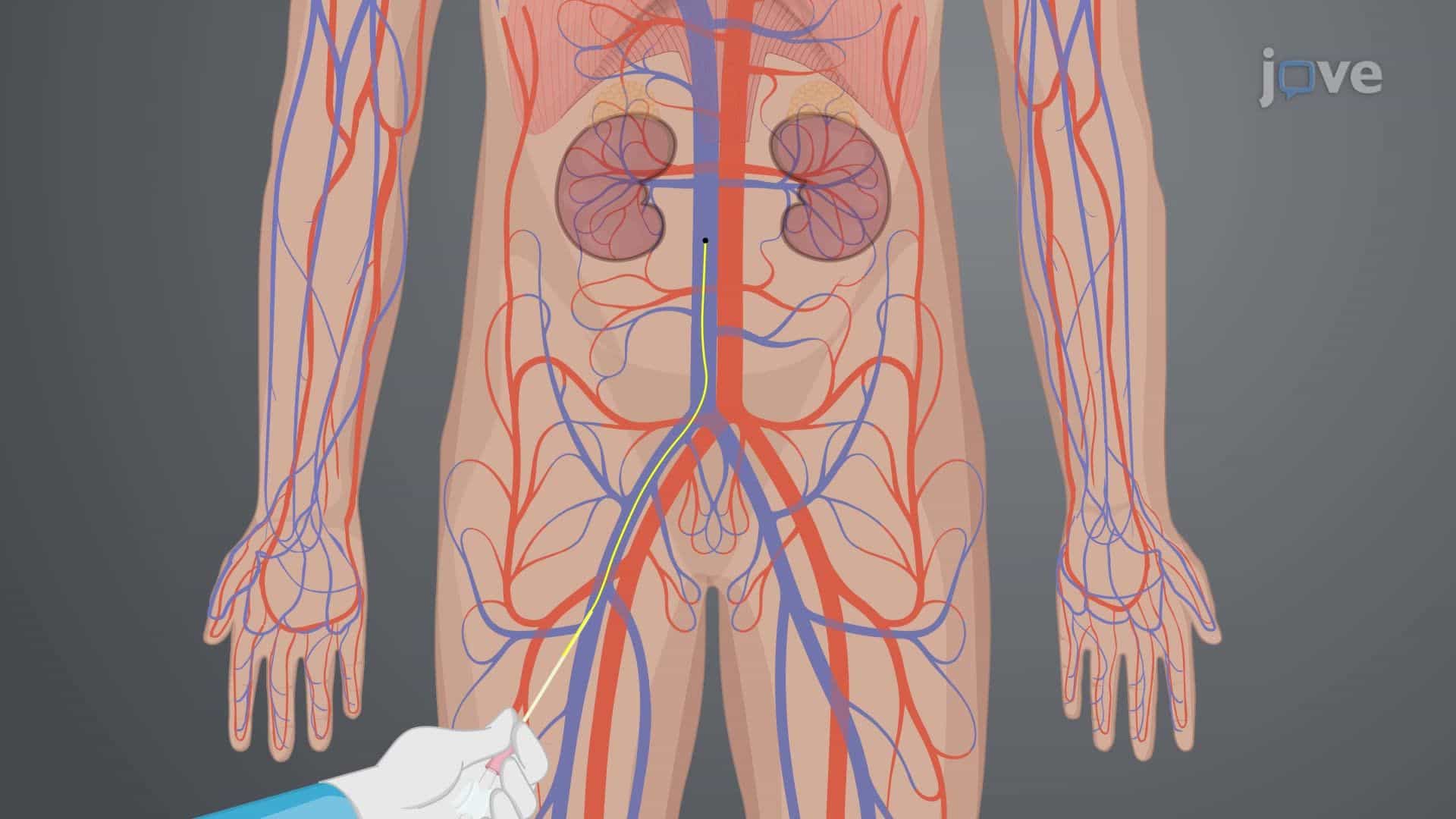 Cardiac Catheterization II: Right Heart Catheterization