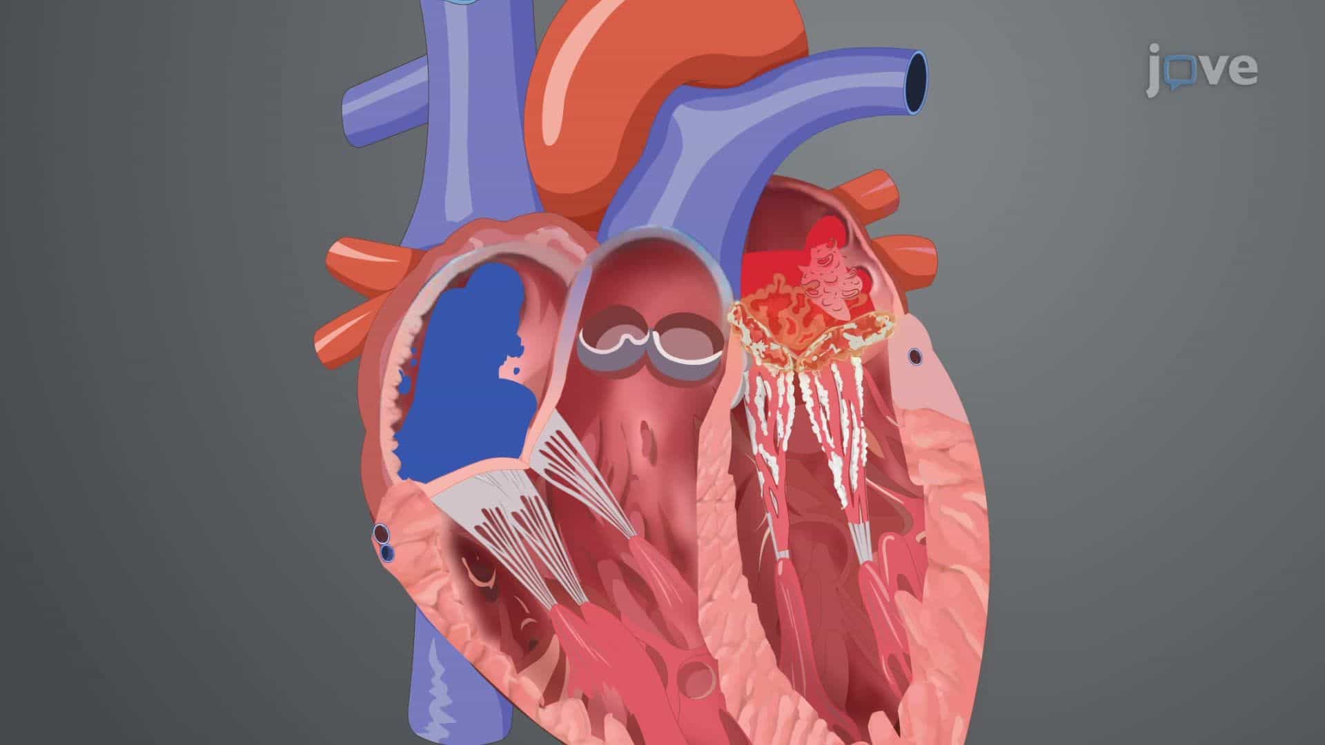 Mitral Stenosis I: Introduction