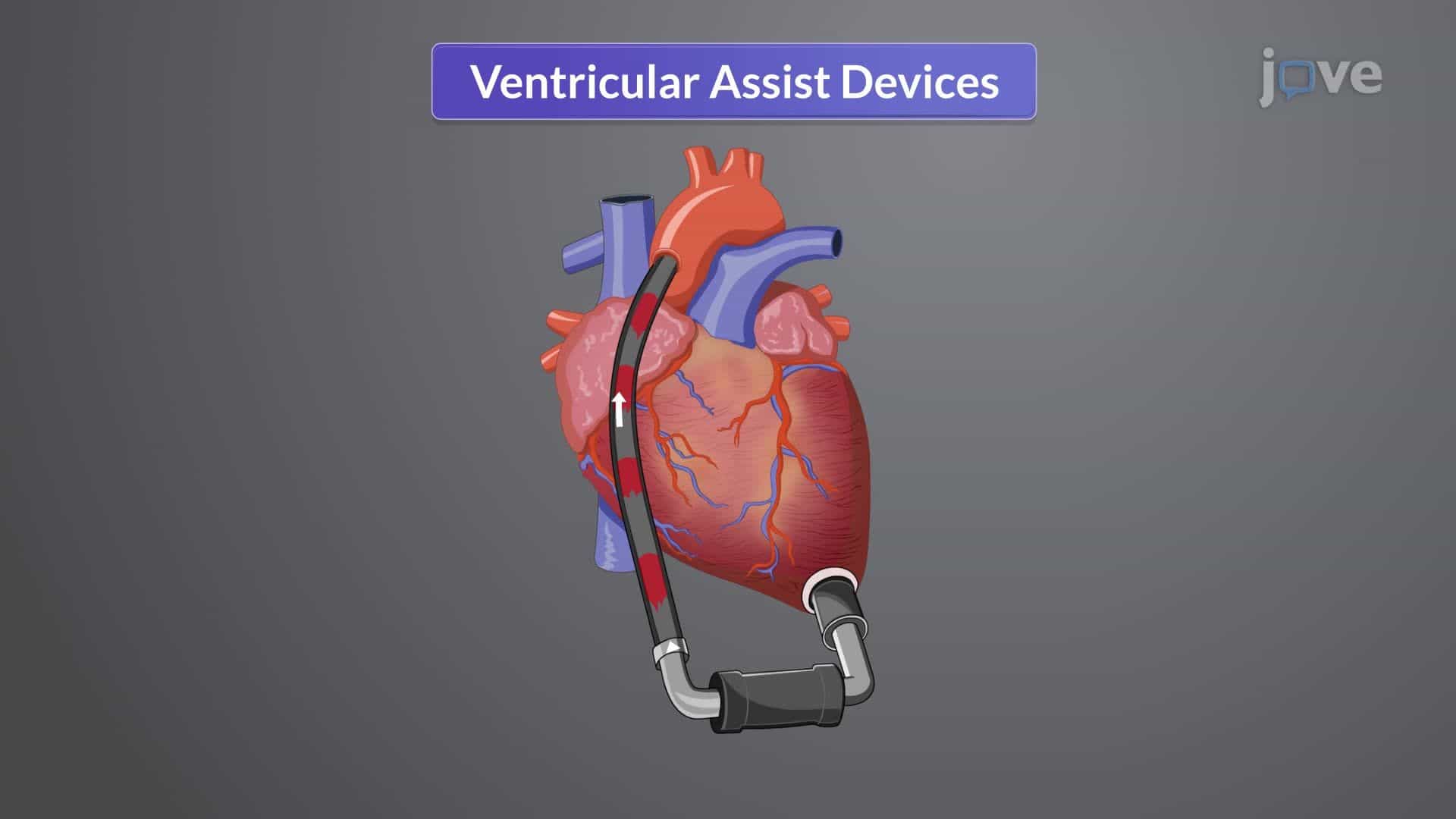 Heart Failure VI: Adjunct Therapies