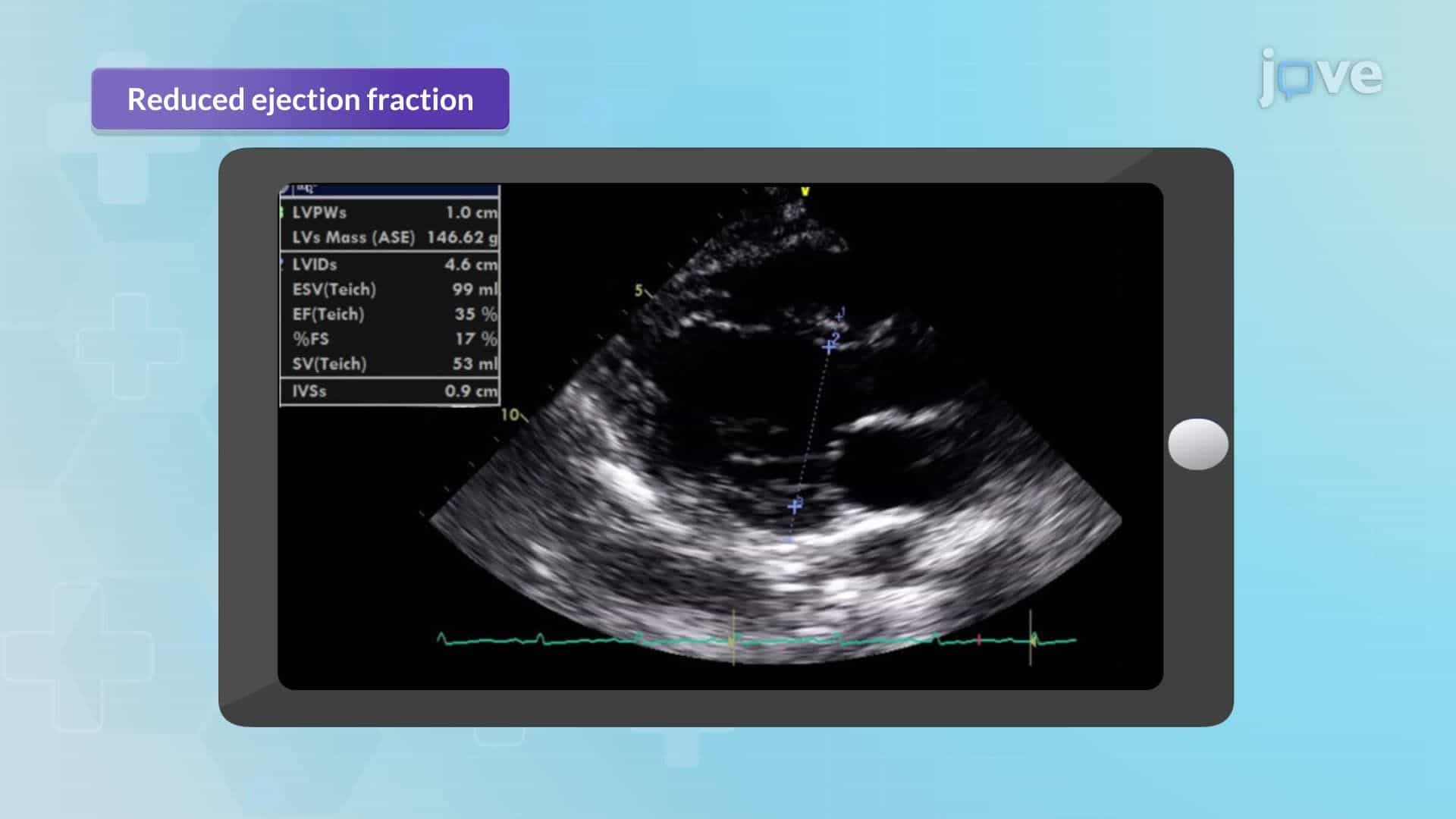Heart Failure VII: Nursing Interventions