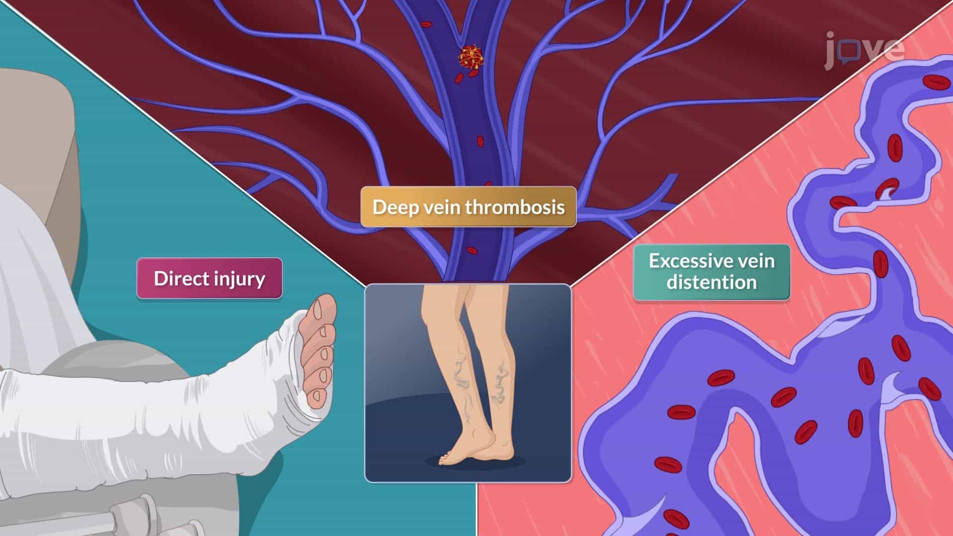 Varicose Veins I: Introduction