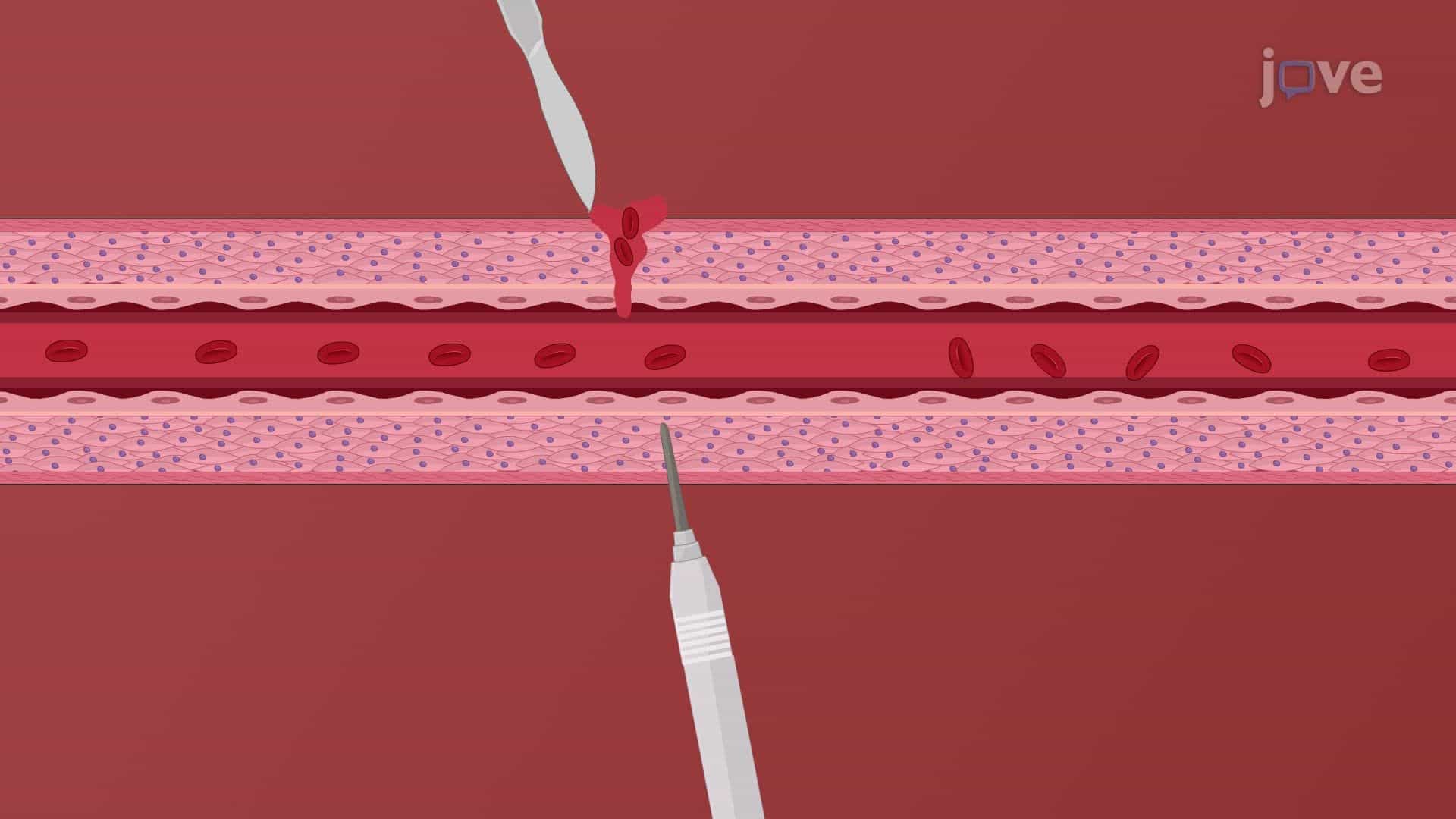 Venous Thrombosis I: Introduction
