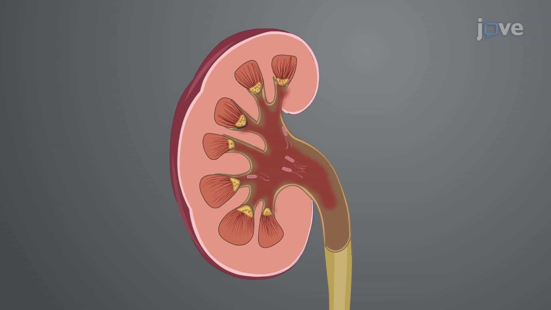 Acute Pyelonephritis I: Introduction