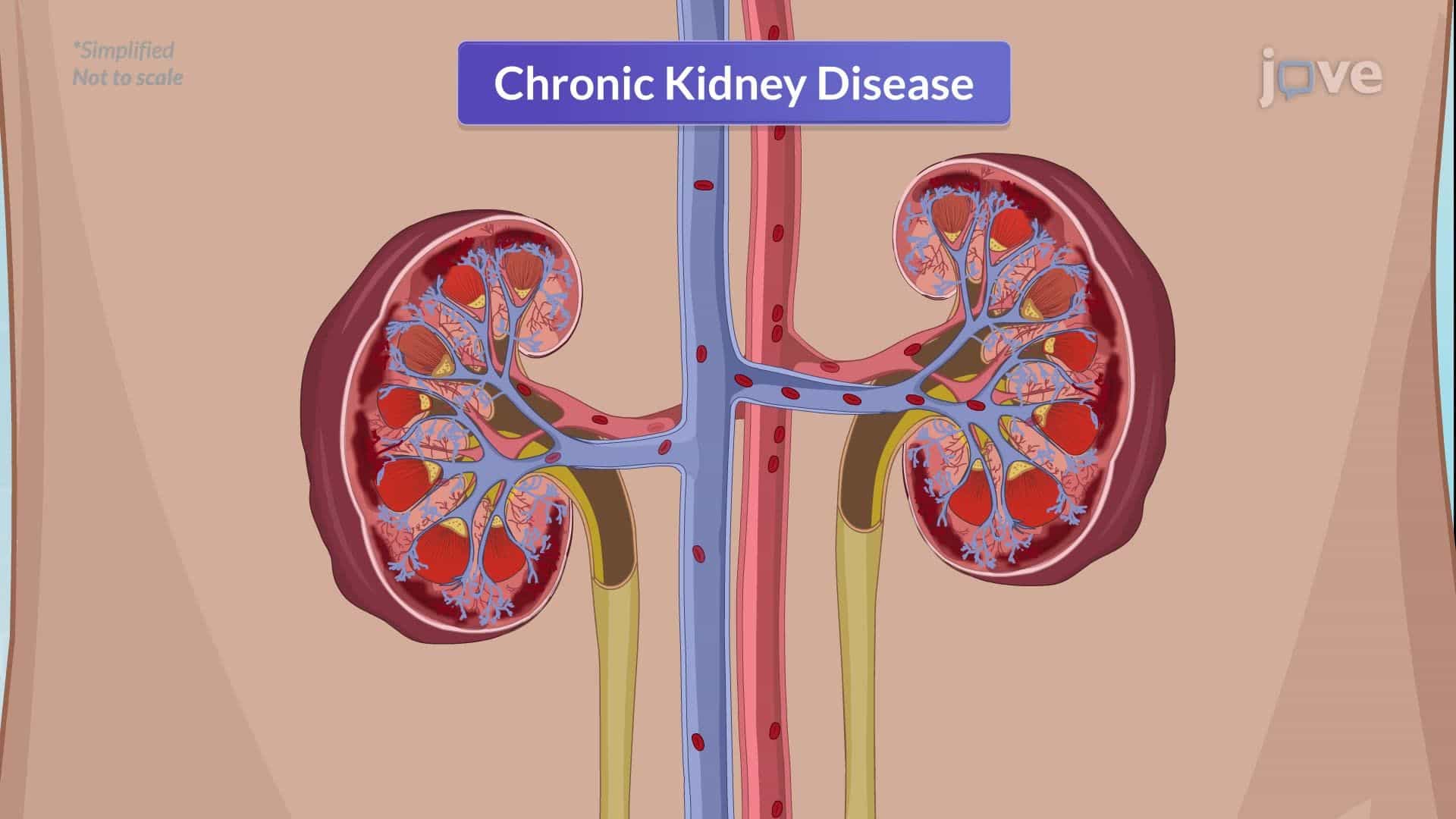 Chronic Kidney Disease II: Clinical Manifestations