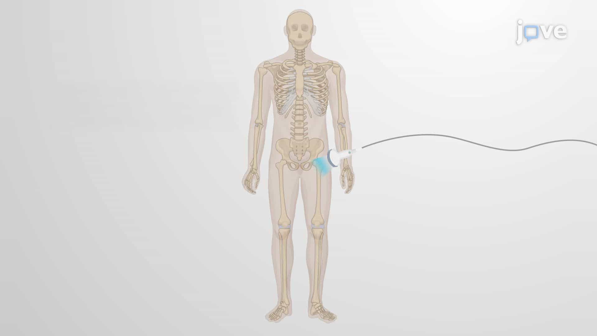 Assessing Bone Mineral Density Using Radiofrequency Echographic Multi-Spectrometry