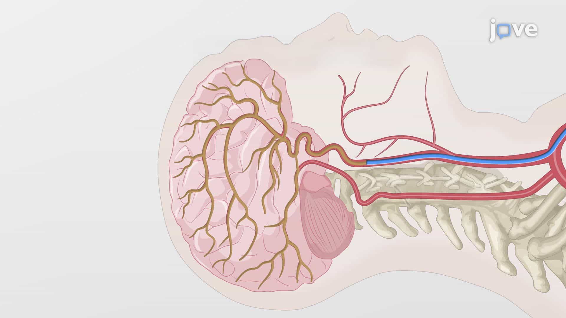 Detection of Internal Carotid Artery Narrowing Using Digital Subtraction Angiography