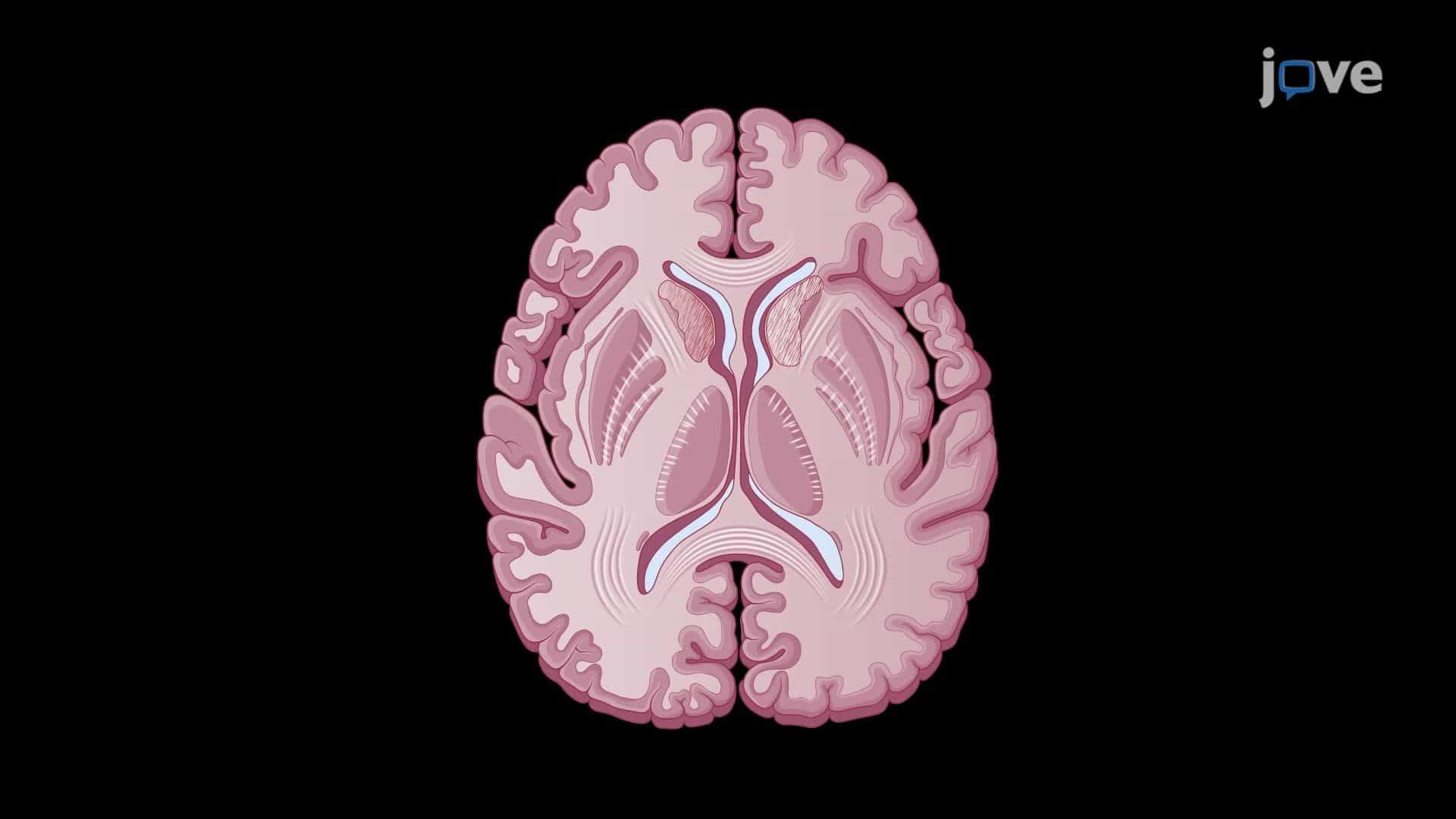 Fluid-Attenuated Inversion Recovery Magnetic Resonance Imaging to Visualize Multiple Sclerosis Lesions