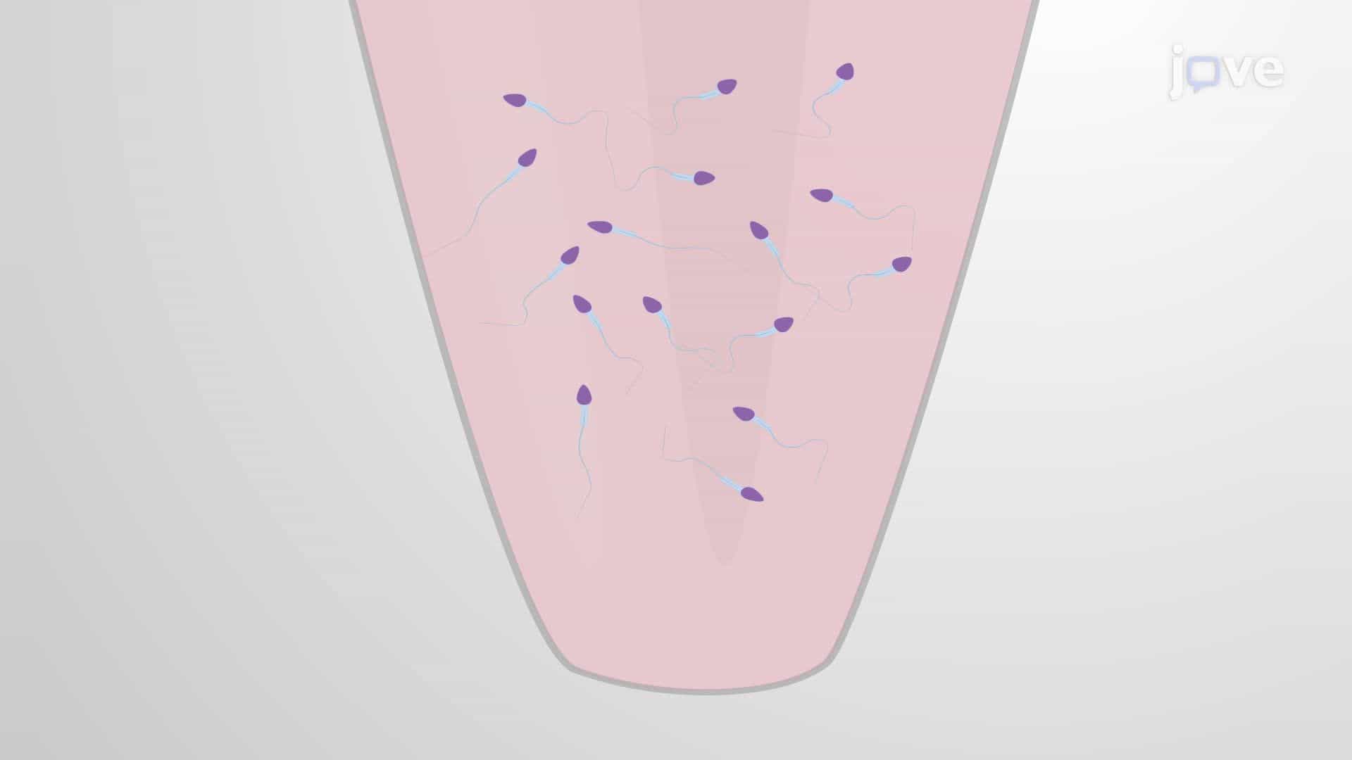 A Technique for Percutaneous Epididymal Spermatozoa Aspiration and Processing