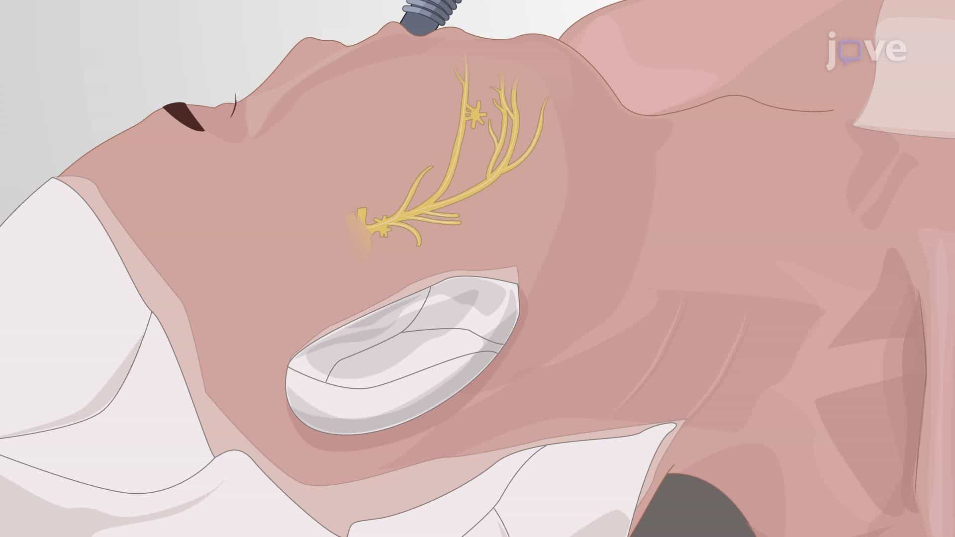 Subcutaneous Trigeminal Nerve Stimulation to Relieve Neuropathic Facial Pain