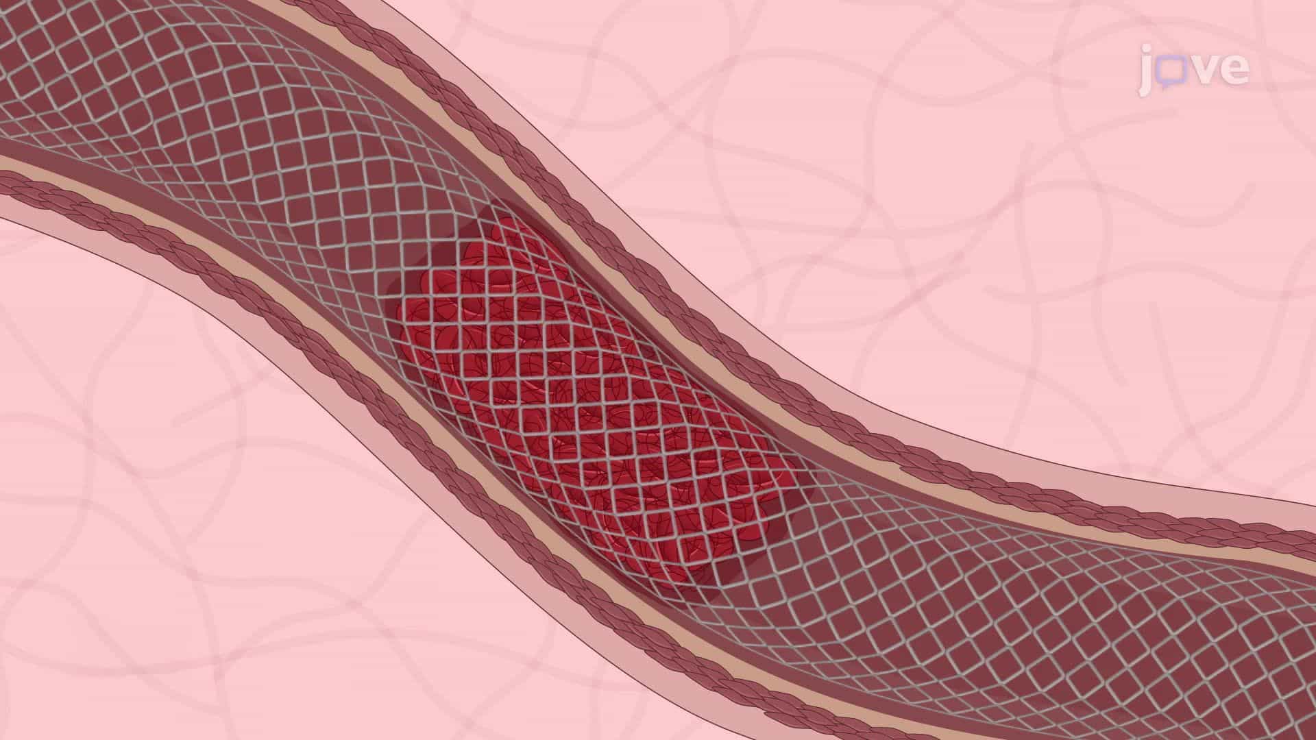 Endovascular Treatment of Acute Ischemic Stroke Using the Stent Retriever-Assisted Vacuum-Locked Extraction Technique