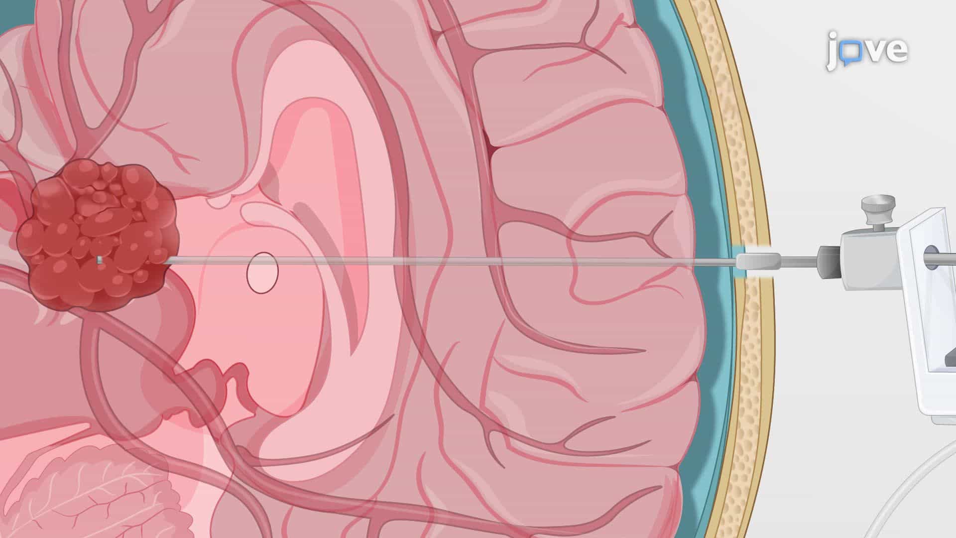 Laser Interstitial Thermal Therapy for Intracranial Tumor Ablation in a Human Patient