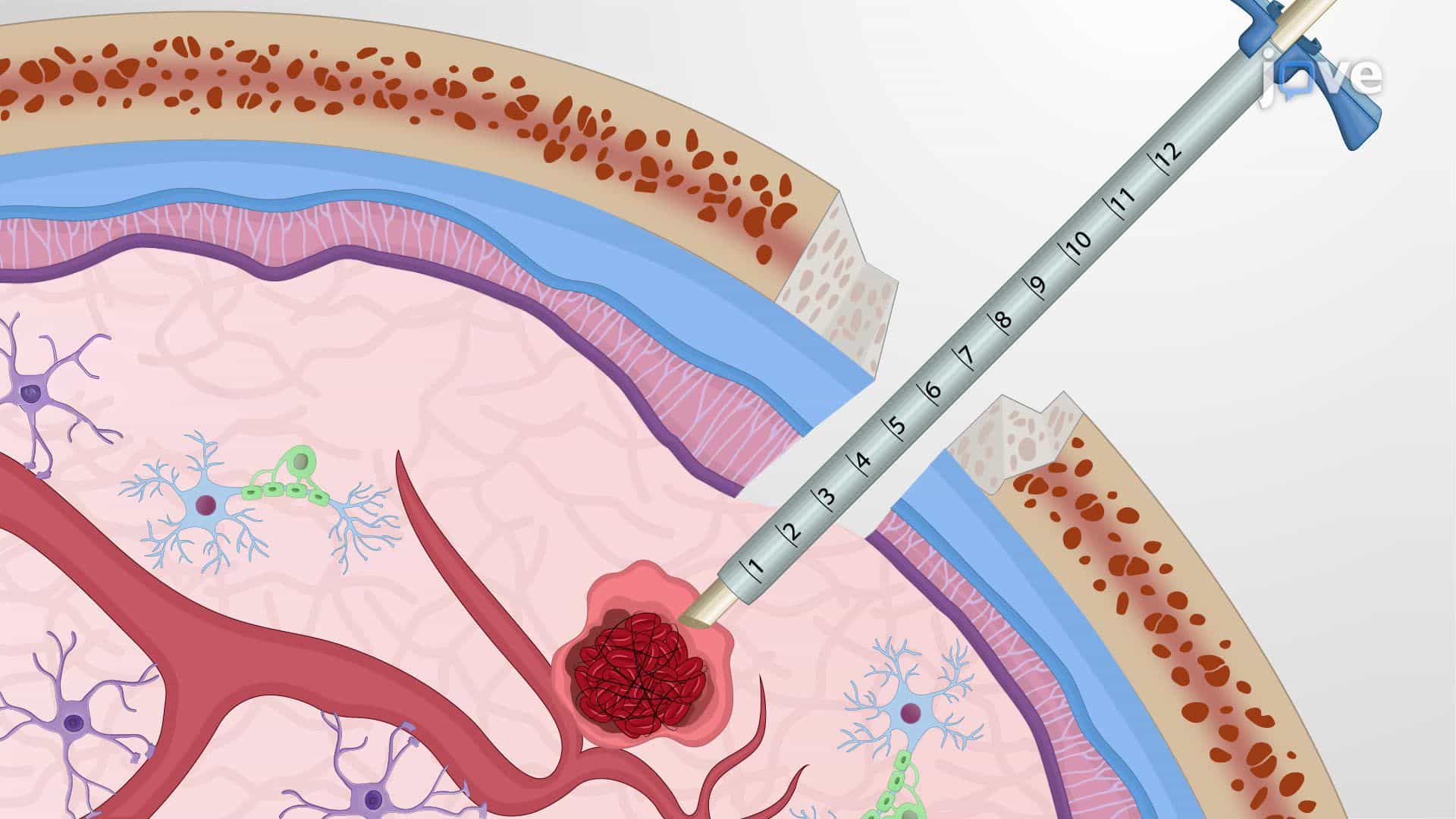 Minimally Invasive Endoscopic Procedure for Hematoma Removal from the Human Brain