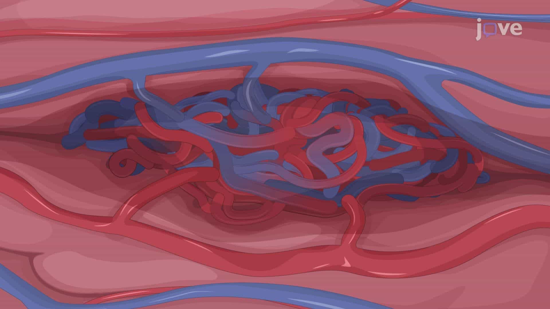 Open Surgical Resection of Cerebral Arteriovenous Malformations