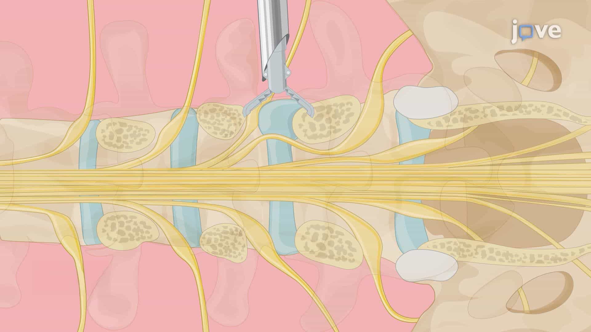 Full-Endoscopic Isolation Zone Technique for the Treatment of Lumbar Disc Herniation