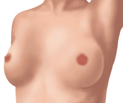 Breast Tissue Anatomy; Tissue and Lymph Node Examination